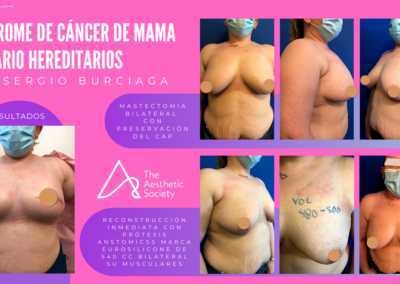 Síndrome de cáncer de mamA y ovario hereditarios